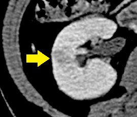 腎細胞がん 右 手術 腹腔鏡下右腎摘出術 腎臓 副腎 尿路系 腎臓 副腎 尿路系 腎細胞がん 右 手術 腹腔鏡下右腎摘出術 医療法人社団公仁会 槇殿順記念病院 まきどのじゅんきねんびょういん