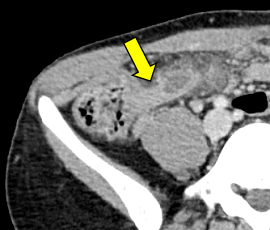 急性虫垂炎 手術 腹腔鏡下虫垂切除術 大腸 症例 急性虫垂炎 手術 腹腔鏡下虫垂切除術 医療法人社団公仁会 槇殿順記念病院 まきどのじゅんきねんびょういん