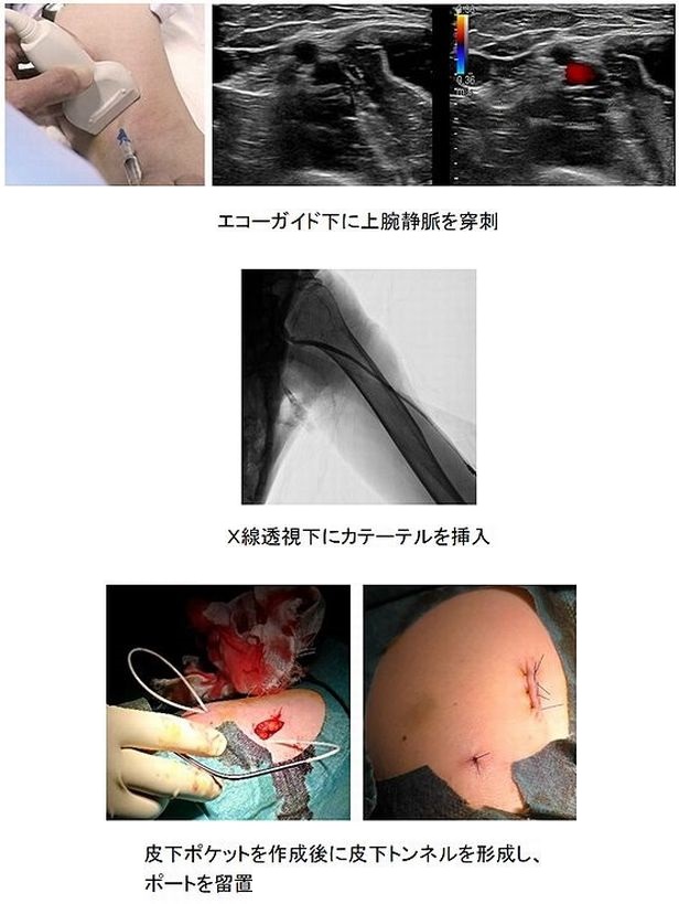 抗悪性腫瘍剤静脈内持続注入用植込型カテーテル設置 頭頸部その他 しろぼんねっと